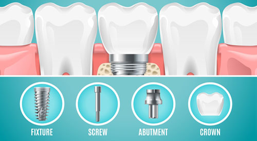 Dental Implant in Nagpur