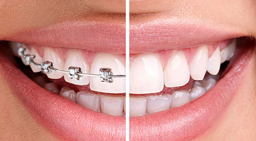 Orthodontic Treatment in Nagpur