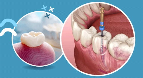 Root Canal Treatment in Nagpur