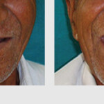 COMPLETE DENTURE PROSTHESIS