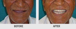 COMPLETE DENTURE PROSTHESIS