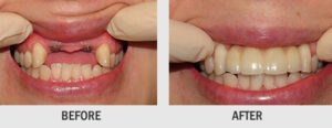 DENTAL IMPLANTS