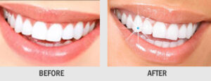 DENTAL JEWELLERY