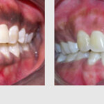 DEPIGMANTATION OF GUMS