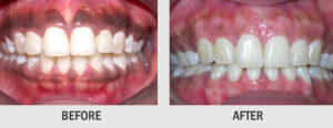 DEPIGMANTATION OF GUMS