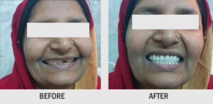 SMILE DESIGN BY USING FIXED TEETH