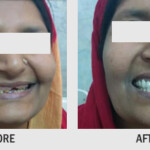 SMILE DESIGN BY USING FIXED TEETH