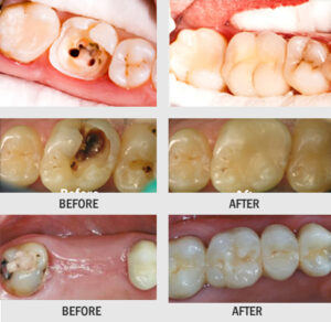 ROOT CANAL TREATMENT AND CAP