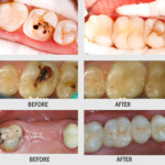 ROOT CANAL TREATMENT AND CAP