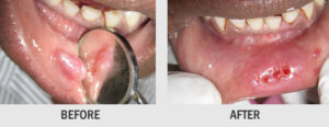 SURGICAL REMOVAL OF INTRAORAL SWELLINGS