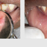 SURGICAL REMOVAL OF INTRAORAL SWELLINGS