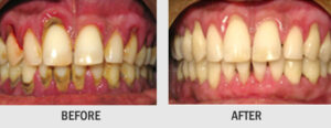 SCALING AND POLISHING