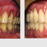 SCALING AND POLISHING