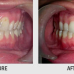 WHITENING OF TEETH BY BLEACHING