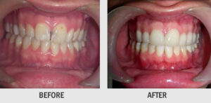 WHITENING OF TEETH BY BLEACHING
