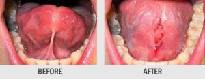 TONGUE TIE OPERATION