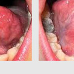 TONGUE TIE OPERATION