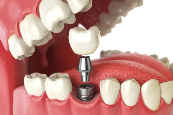 Dental-Implants3 Dental-Implants3