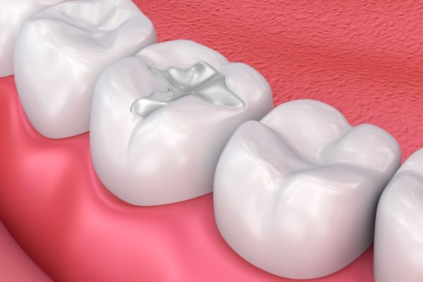 Fillings12 Fillings12