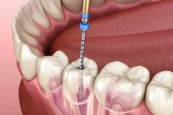 Root-Canal-Treatment Root-Canal-Treatment