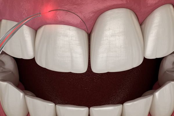 gum-surgery gum-surgery