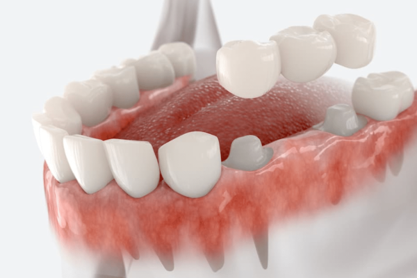 how-to-fix-the-gap-between-crown-and-gum how-to-fix-the-gap-between-crown-and-gum