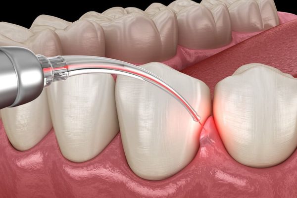laser-dentistry-L laser-dentistry-L
